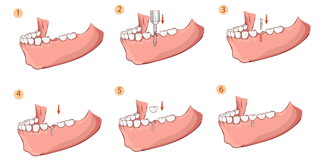 תהליך השתלת שיניים,השיניים קודם כל קודחים אל