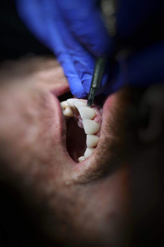 טיפול ציפוי שיניים