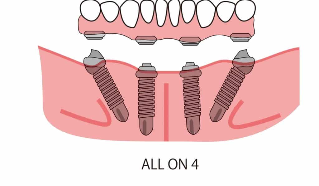 All on 4 השתלת רצף של שתלים בשיטת