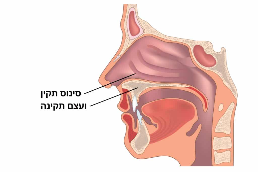 אין צורך בהרמת סינוס