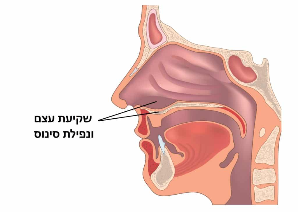 מבנה הדורש ניתוח הרמת סינוס