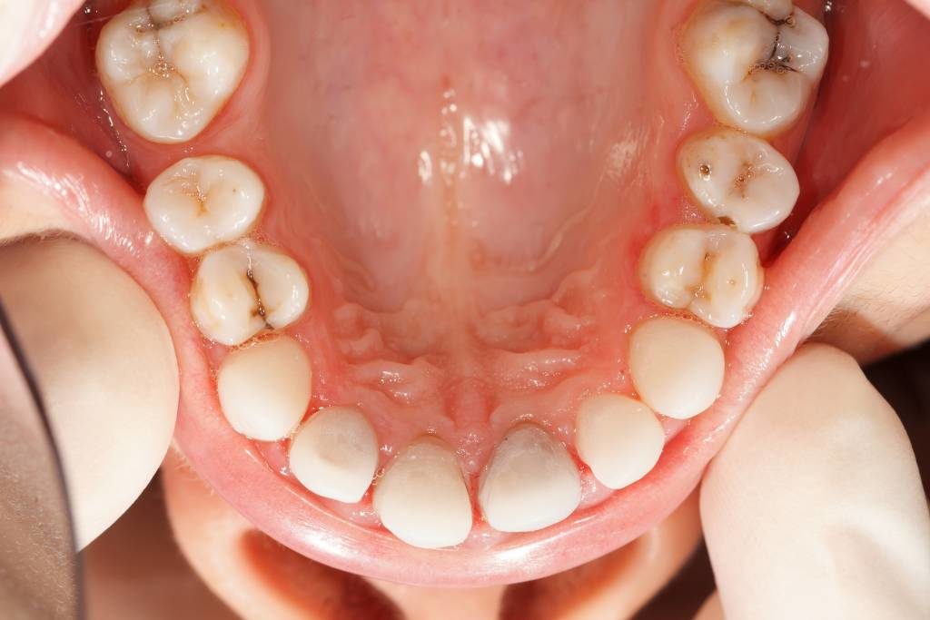 סט של כתרי זירקוניה קדמיים בפה של מטופל