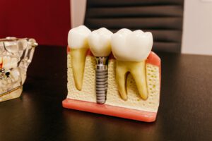 השתלת שיניים: סקירה מקיפה עבור המטופל המודרני