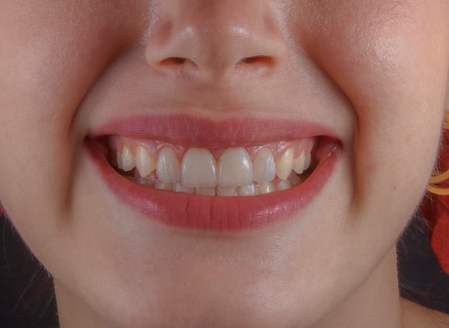 עיצוב שיניים דיגיטלי – העתיד כבר כאן